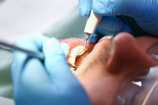 Best Emergency Dental Care for Abscessed Tooth in Mattydale, NY